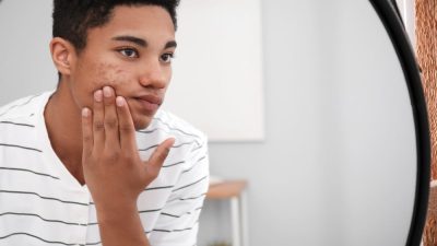 adolescent acne juvenile