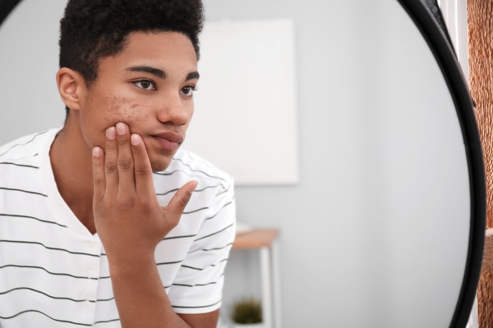 adolescent acne juvenile