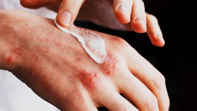 homme applique creme sur eczema mains